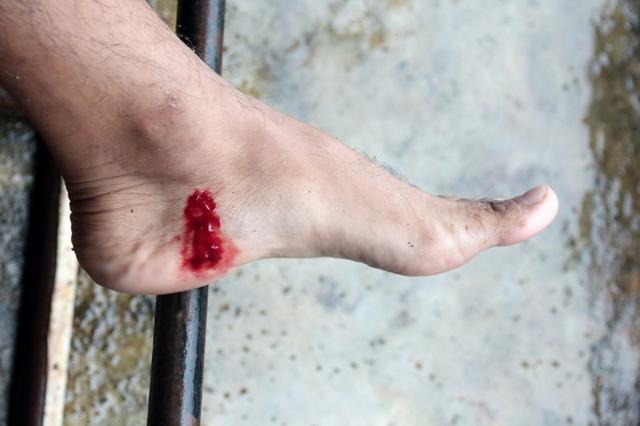 參加戶外徒步登山活動,被螞蟥吸血了怎么辦?