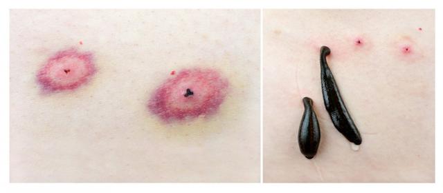 參加戶外徒步登山活動,被螞蟥吸血了怎么辦?