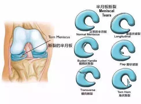 戶外爬山一定需要護膝嗎？戶外運動護膝到底有用嗎？