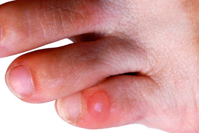 腳上起泡怎么辦,徒步愛好者必看怎樣預防和處理腳上起泡