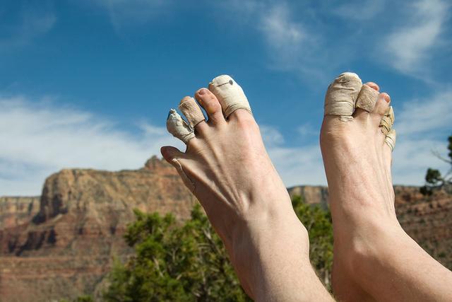 腳上起泡怎么辦,徒步愛好者必看怎樣預防和處理腳上起泡