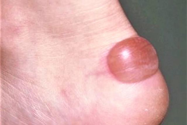 腳上起泡怎么辦,徒步愛好者必看怎樣預防和處理腳上起泡